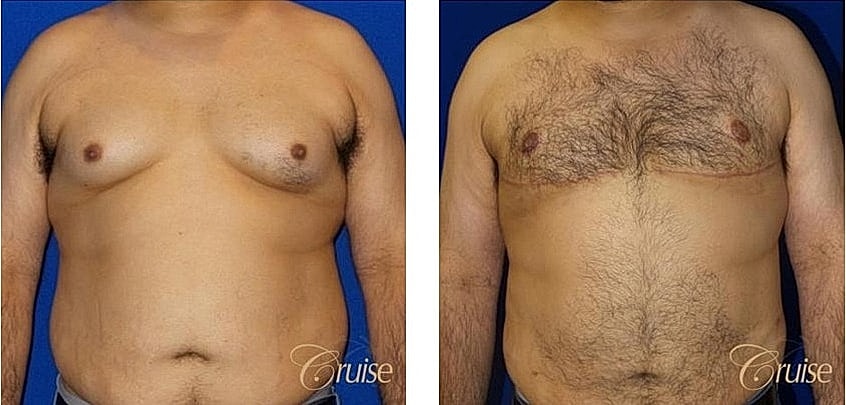 Before and after chest appearance comparison