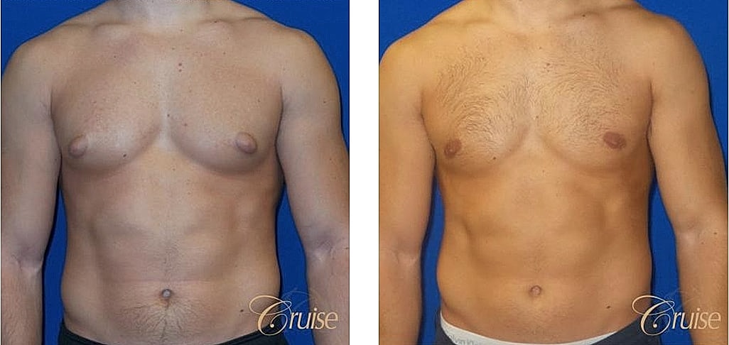 Before and after photo of male physique.