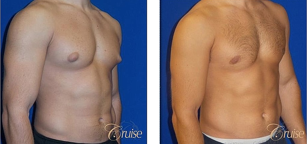 Before and after body transformation comparison.