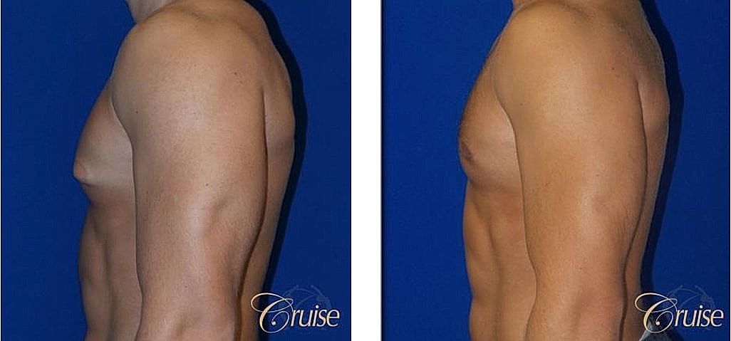 Before and after body contouring comparison photos.