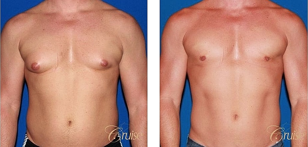 Before and after body transformation comparison.