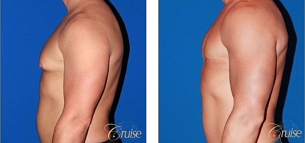Before and after body transformation comparison photo.