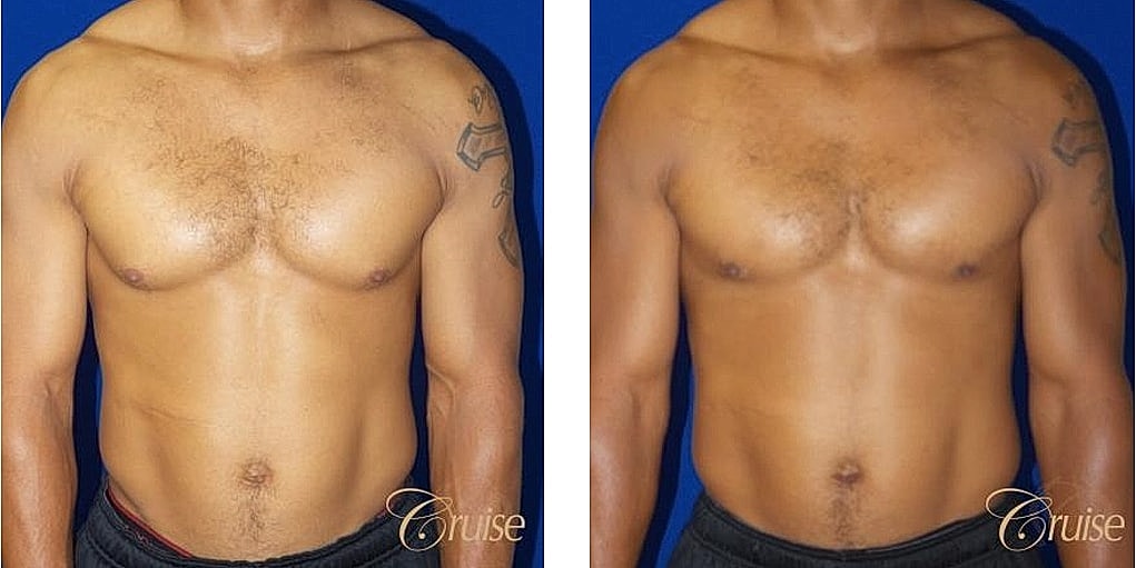 Before and after male chest comparison photos