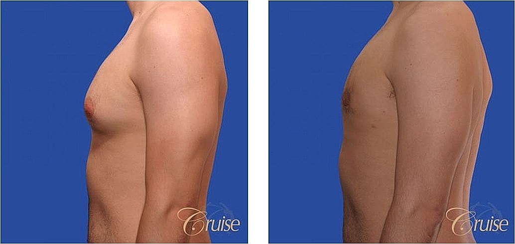 Before and after chest appearance comparison.