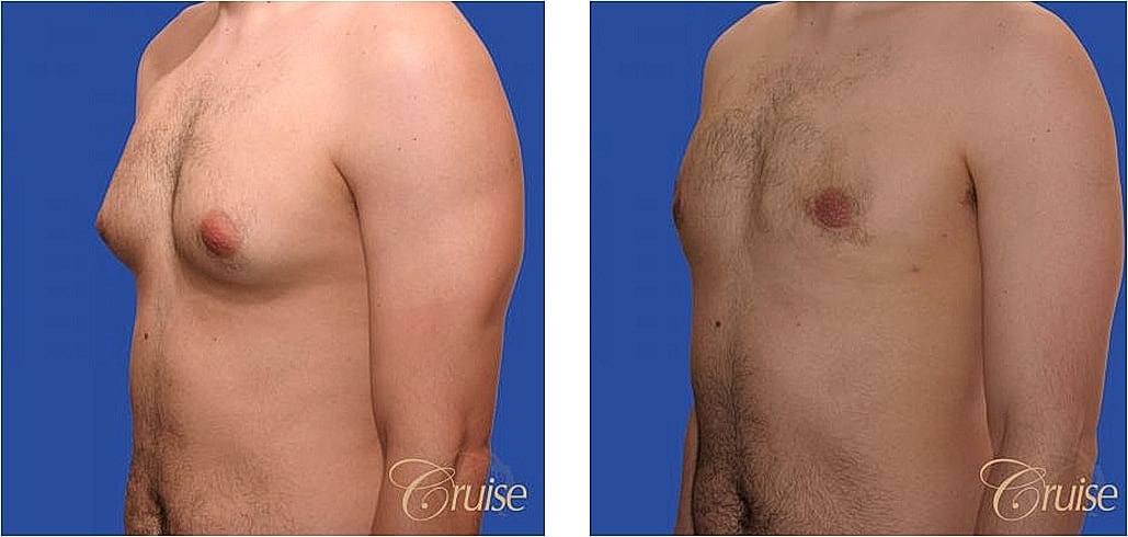 Before and after chest appearance comparison.