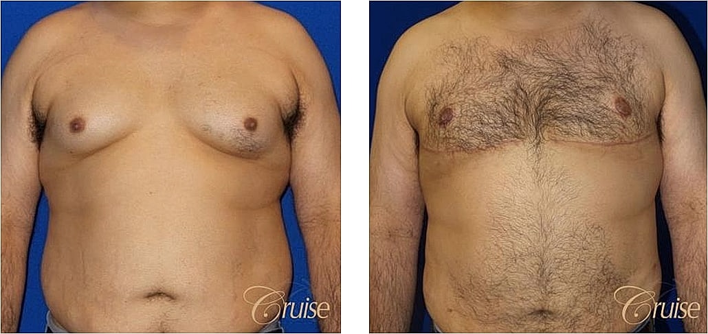 Before and after body contouring results.