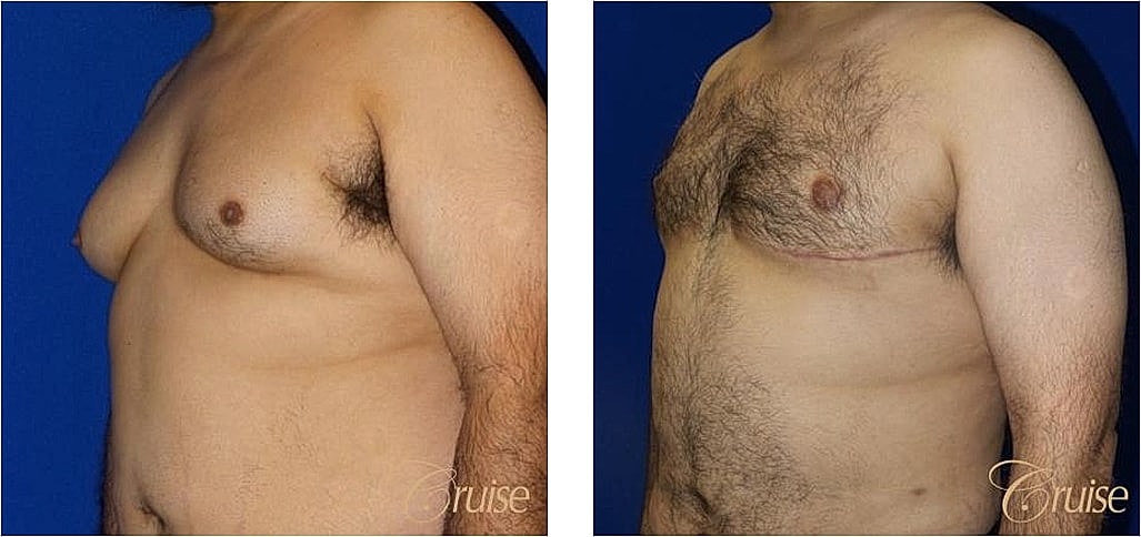 Before and after photos of chest surgery.