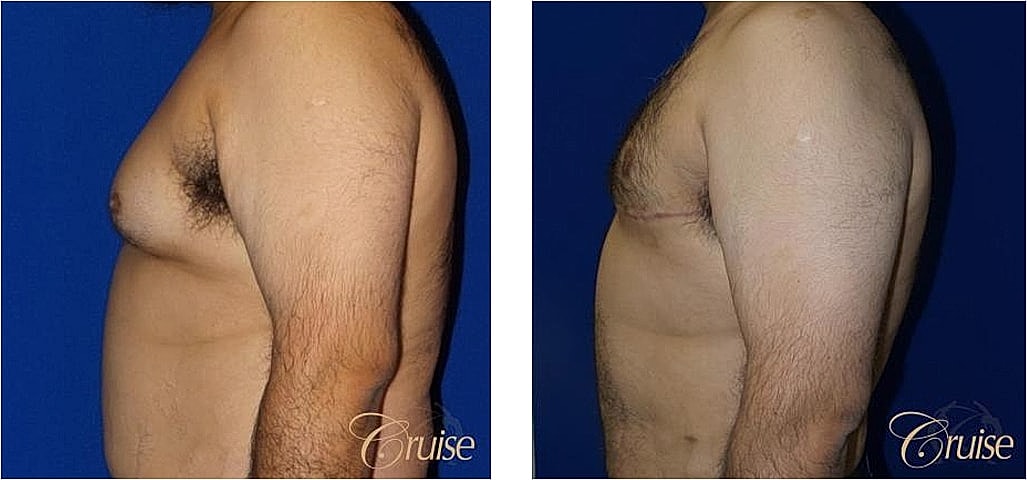 Before and after body contouring surgery comparison.