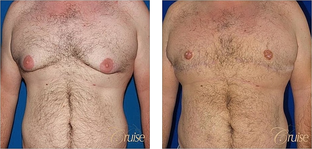 Before and after chest appearance comparison.