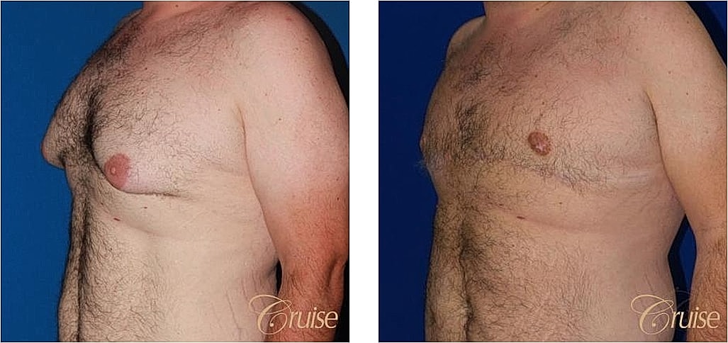 Before and after photos of male chest surgery.