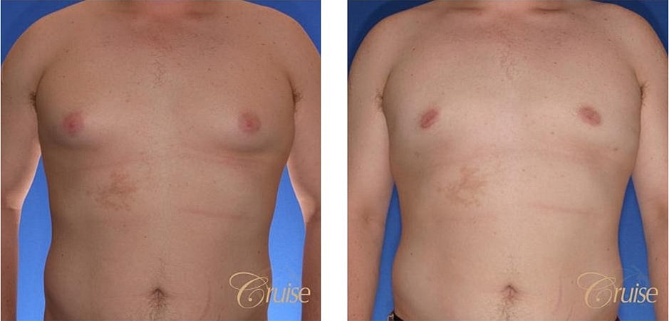 Type 2 Gynecomastia Before & After