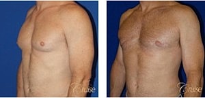 Type 3 Gynecomastia Before & After