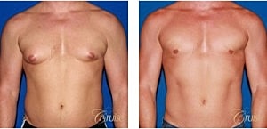 Type 3 Gynecomastia Before & After