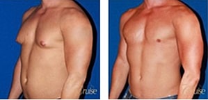 Type 3 Gynecomastia Before & After