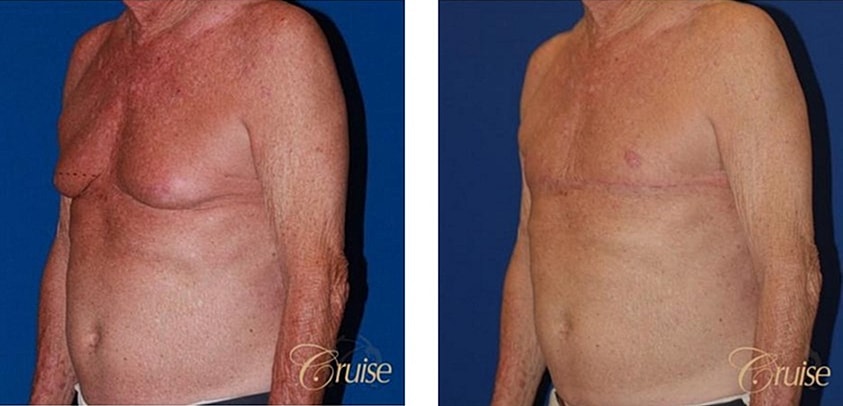 Type 4 Gynecomastia Before & After