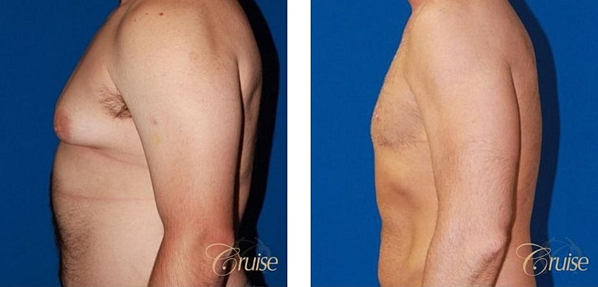 Type 4 Gynecomastia Before & After