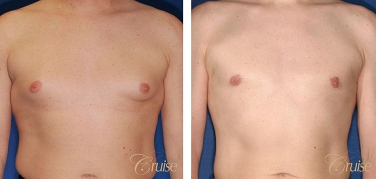 Before and after chest transformation results.