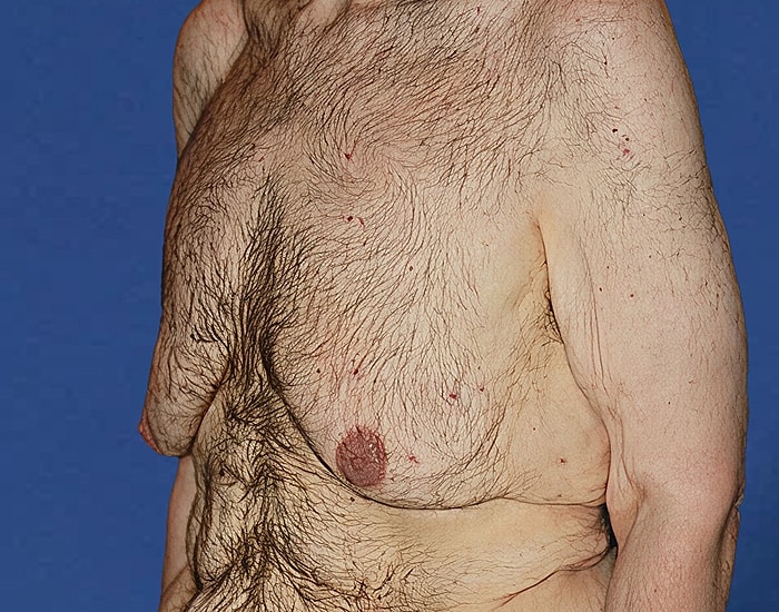 Man with hairy chest and unusual nipple appearance
