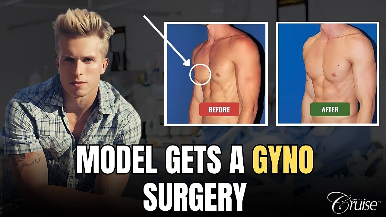 Model's transformation from gynecomastia surgery.